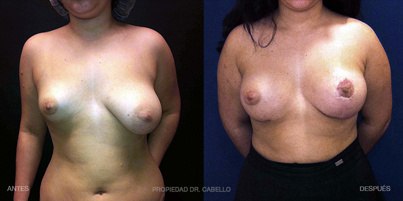 2-Mastopexia CON implantes