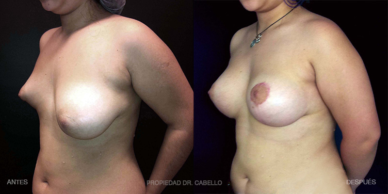 1-Mastopexia CON implantes