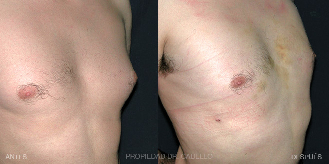 1-Mastopexia CON implantes