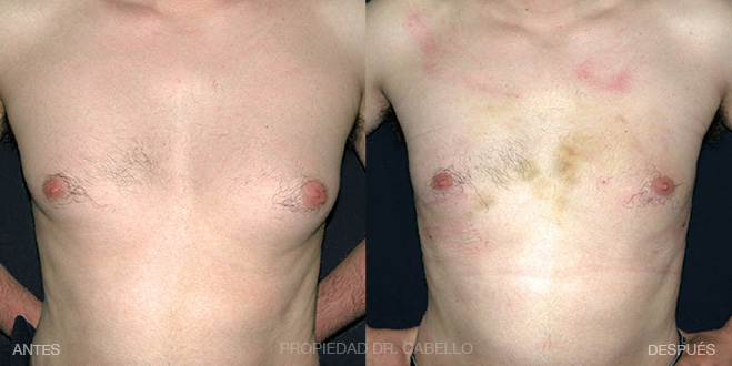2-Mastopexia CON implantes