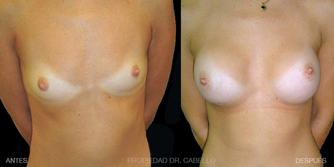 antes y despues caso de cirugia mamaria doctor cabello